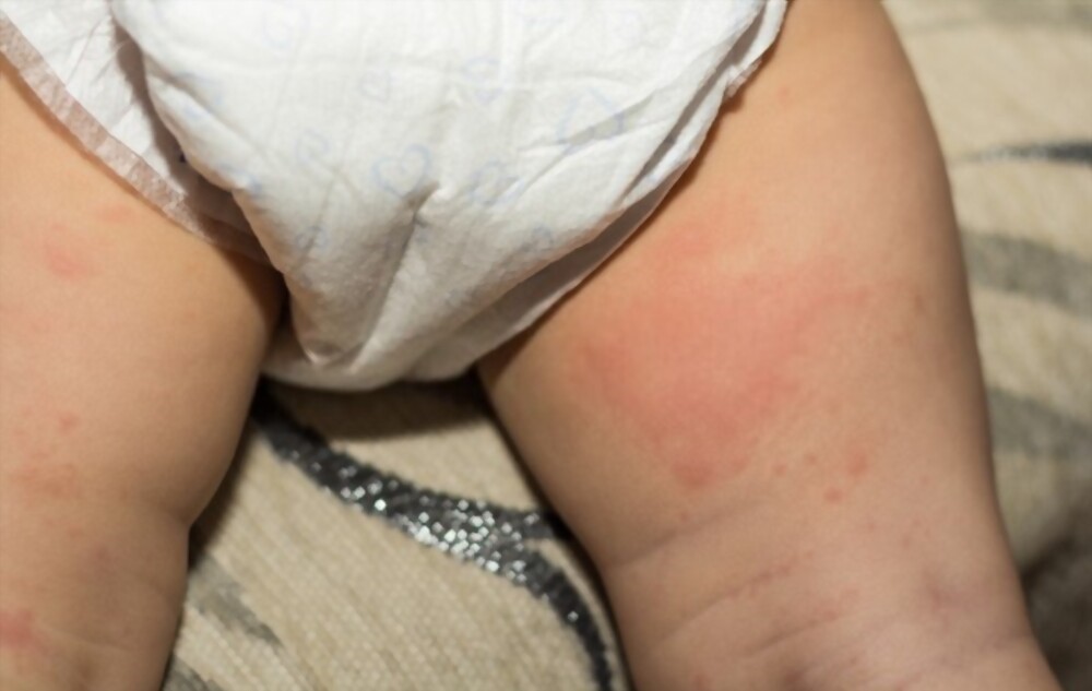 NATURAL DIAPER RASH TREATMENTS – HOME REMEDIES